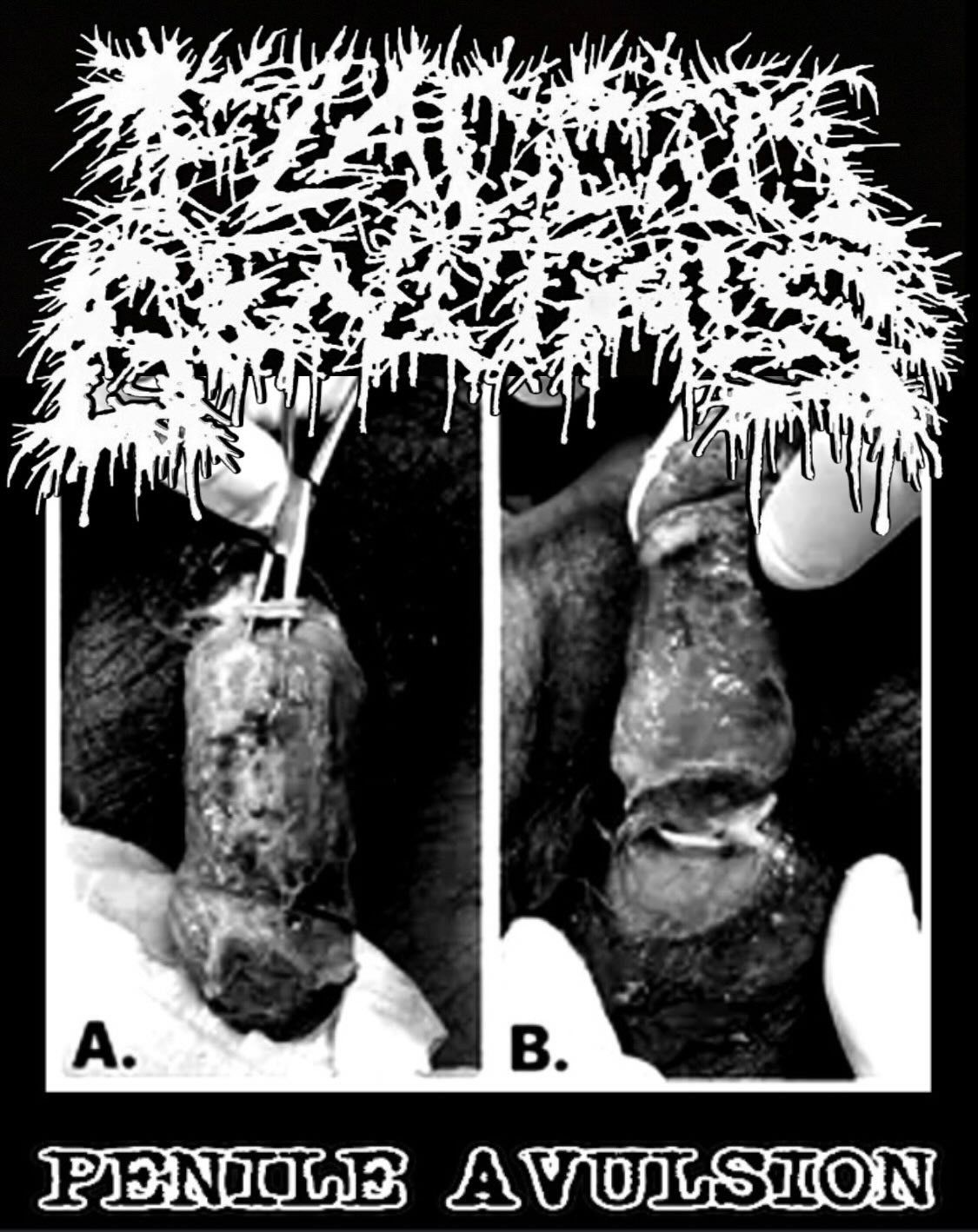 Flaccid Genitals- Penile Avulsion Shirt