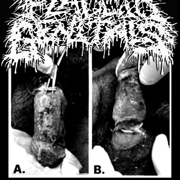 Flaccid Genitals- Penile Avulsion Shirt