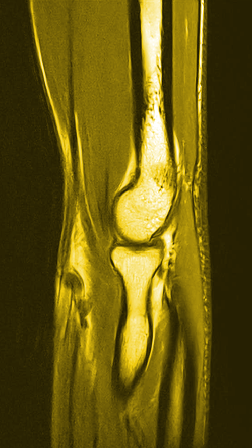 I lamented when her figure left, lest I lose another Lligament. 