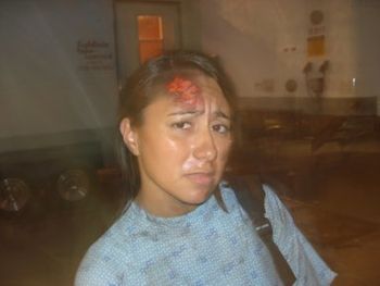 As Burn Victim

