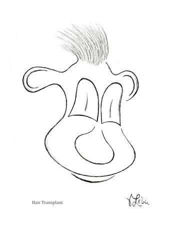 Hair Transplant

